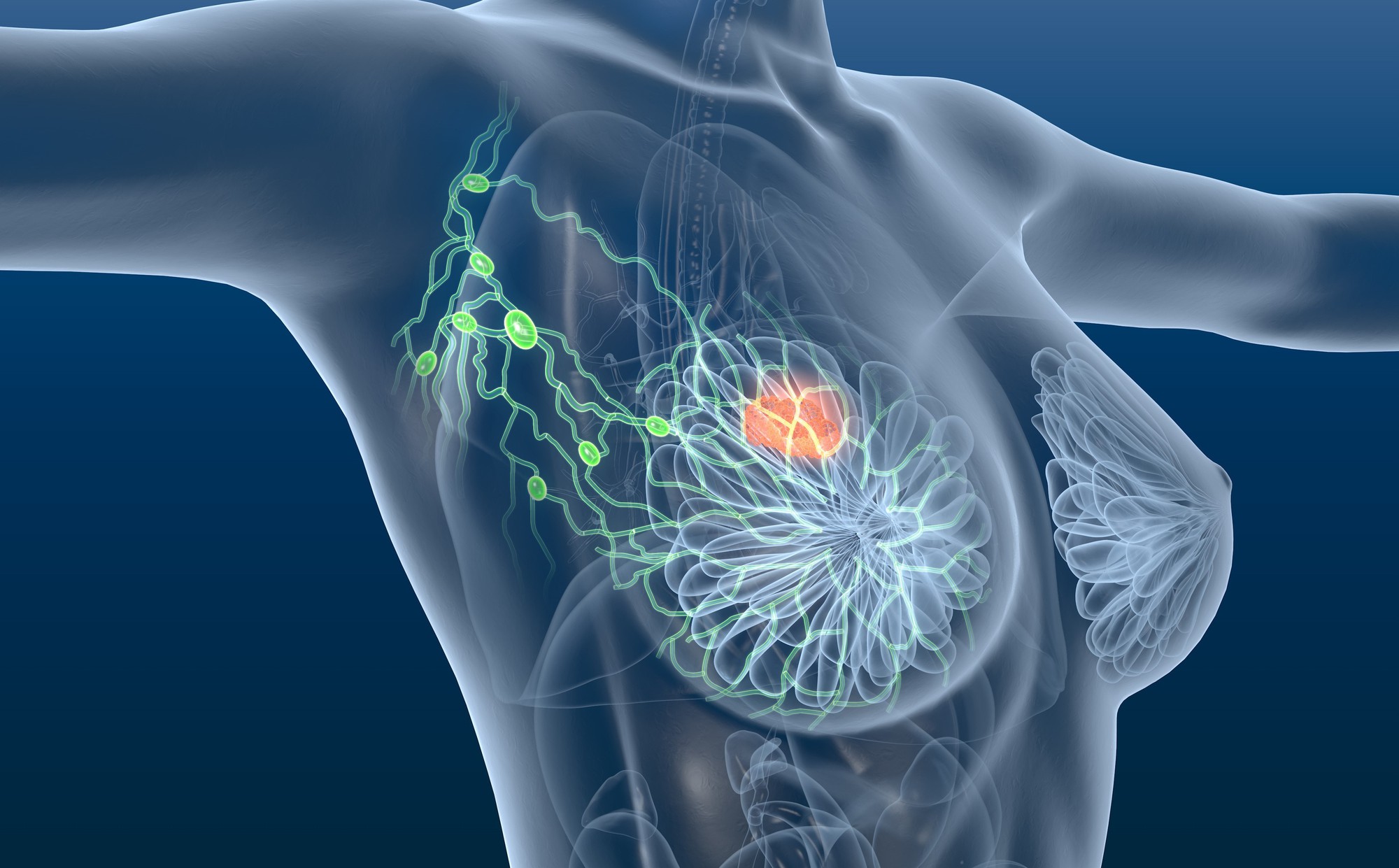 Ung thư vú có phải do gene không?- Ảnh 1.