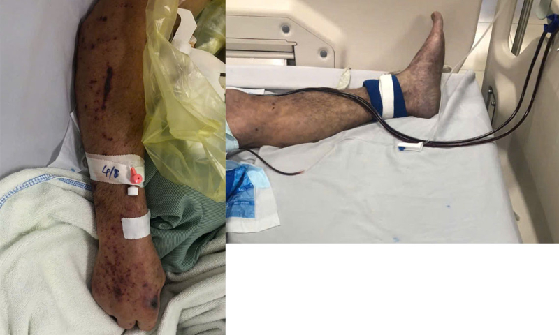 Người đàn ông ở Hưng Yên nguy kịch, tím toàn thân sau chế biến thịt lợn sống, bác sĩ khuyến cáo 3 không- Ảnh 1.