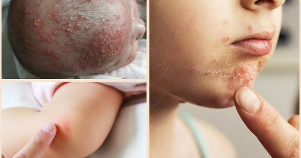 Khi viêm nang lông không còn là chuyện da liễu đơn giản