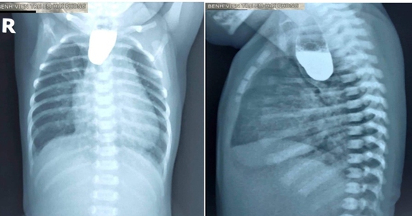 Teo thực quản nguy hiểm như thế nào?