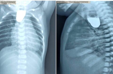 Teo thực quản nguy hiểm như thế nào?