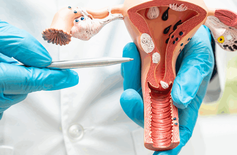 4 nhóm phụ nữ có nguy cơ cao mắc ung thư cổ tử cung