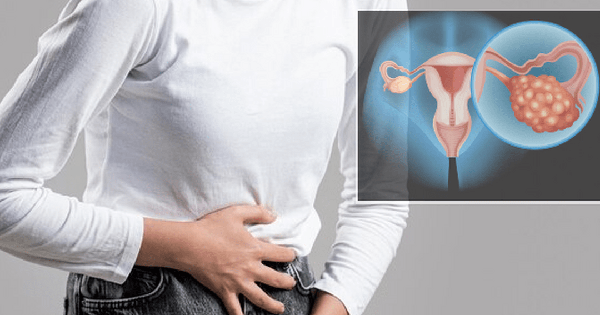 Có thể phát hiện sớm ung thư buồng trứng không?