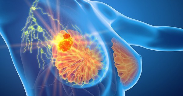 Tầm soát ung thư vú có nhất thiết phải chụp nhũ ảnh hay không?