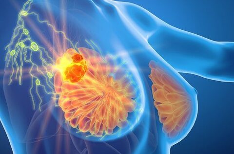 Tầm soát ung thư vú có nhất thiết phải chụp nhũ ảnh hay không?