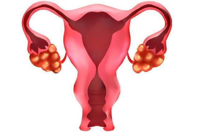 70% ung thư buồng trứng được chẩn đoán ở giai đoạn cuối: Phụ nữ sau tuổi 40 nếu gặp triệu chứng này cần khám ngay- Ảnh 2.