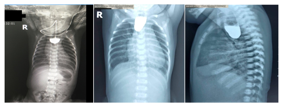 Teo thực quản nguy hiểm như thế nào?- Ảnh 1.