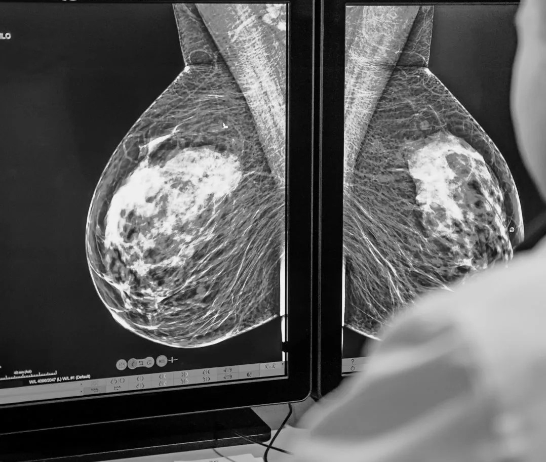Sự khác biệt giữa chụp nhũ ảnh sàng lọc và chụp nhũ ảnh chẩn đoán ung thư vú- Ảnh 2.