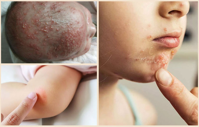 Viêm nang lông ở trẻ có nguy hiểm không?- Ảnh 1.