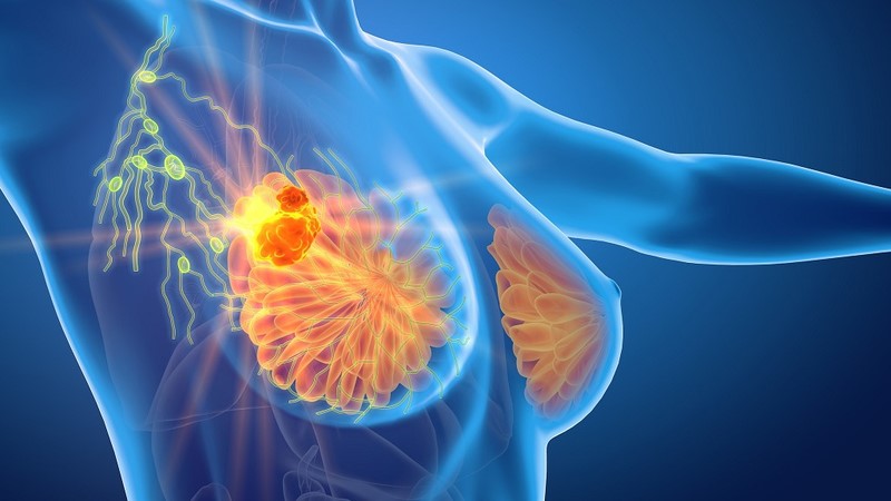 Tầm soát ung thư vú có nhất thiết phải chụp nhũ ảnh hay không?- Ảnh 1.