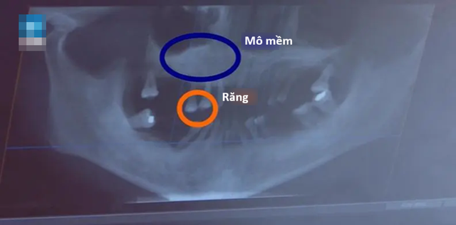 Người phụ nữ 44 tuổi rụng gần hết răng vì thói quen ai cũng dễ bỏ qua- Ảnh 2.
