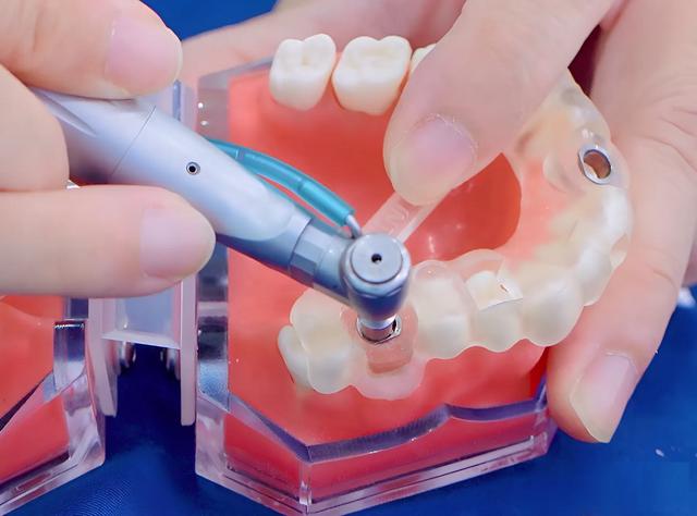 Nhược điểm của trồng răng Implant: Liệu Implant có thực sự hoàn hảo?- Ảnh 3.