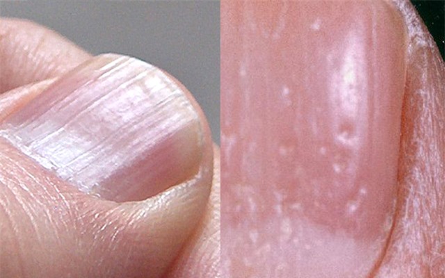 5 dấu hiệu xấu xí trên bàn tay cảnh báo thận của bạn đang kêu cứu!- Ảnh 2.