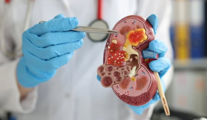 Trẻ em đối mặt biến chứng nguy hiểm từ thận hư kháng thuốc- Ảnh 1.