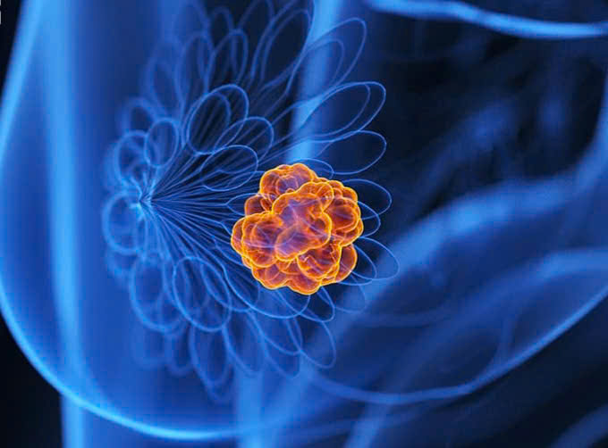 Trí tuệ nhân tạo (AI) giúp phát hiện chính xác ung thư vú- Ảnh 1. Trí tuệ nhân tạo (AI) giúp phát hiện chính xác ung thư vú- Ảnh 1.