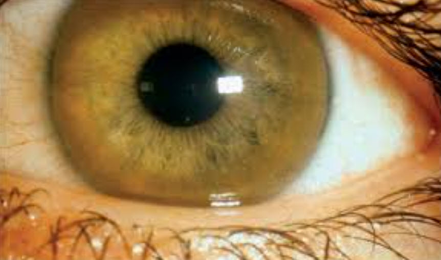 Bệnh Wilson khiến gan và não trẻ bị “tấn công” âm thầm- Ảnh 2.