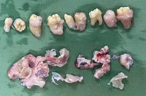 Bác sĩ phẫu thuật ‘nhổ’ 10 cái răng trong bụng bệnh nhân có khối u quái buồng trứng