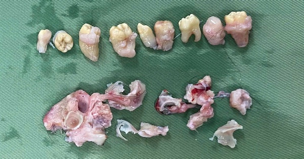 Bác sĩ phẫu thuật ‘nhổ’ 10 cái răng trong bụng bệnh nhân có khối u quái buồng trứng