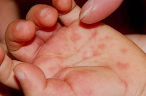 Số ca mắc tay chân miệng tại TP. Hồ Chí Minh tăng mạnh