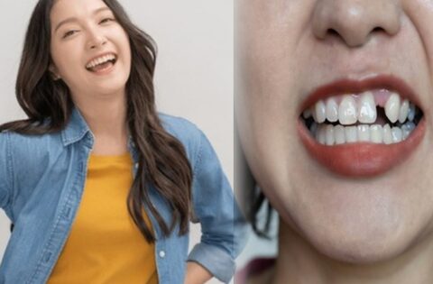 Trồng răng Implant: Đầu tư một lần, hiệu quả trọn đời, nâng cao chất lượng cuộc sống