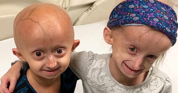 Trẻ nhỏ già đi như người già: Bí ẩn gen lỗi trong hội chứng Progeria