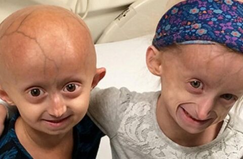 Trẻ nhỏ già đi như người già: Bí ẩn gen lỗi trong hội chứng Progeria