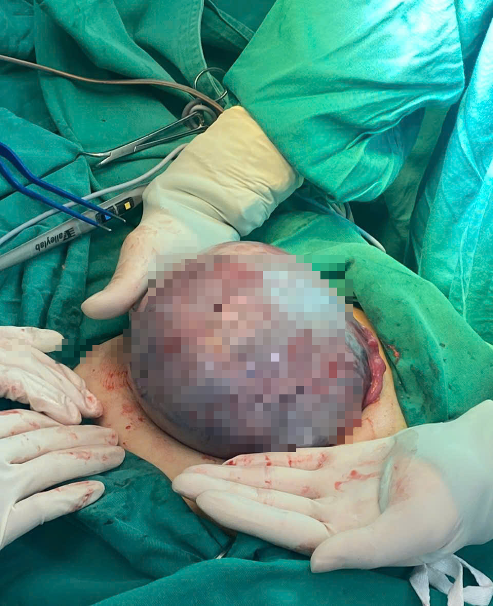 5 biến chứng do u xơ tử cung khiến bệnh nhân phải đi khám nhiều nhất- Ảnh 3.