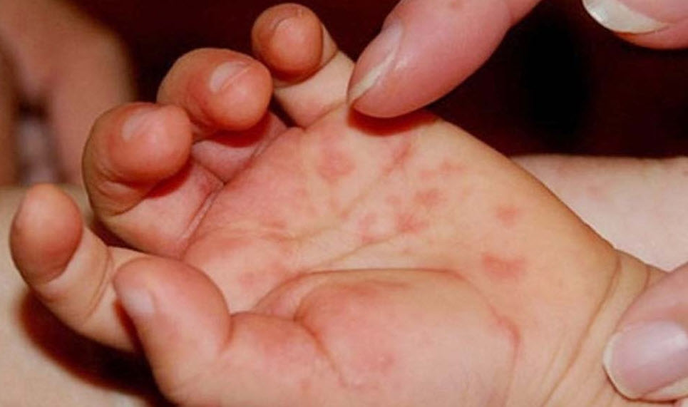 Số ca mắc tay chân miệng tại TP. Hồ Chí Minh tăng mạnh, cách nào phòng ngừa cho trẻ?- Ảnh 2.
