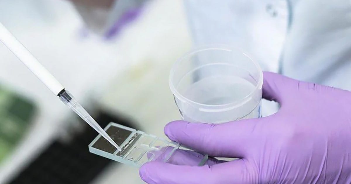 Phương pháp lọc rửa tinh trùng bằng dòng vi dịch (MFSS) | 2025