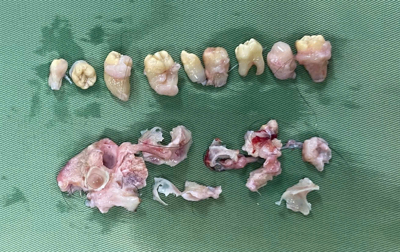 Hy hữu: Bác sĩ phẫu thuật 'nhổ' 10 cái răng trong bụng bệnh nhân có khối u quái buồng trứng- Ảnh 2.