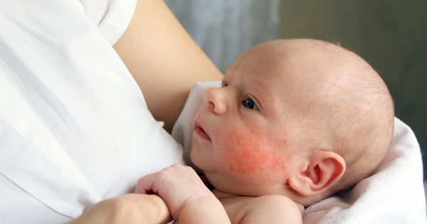 Trẻ em hay mắc các bệnh dị ứng nào?