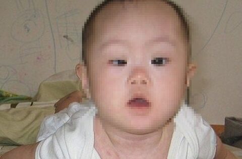 Bé mệt bất thường có thể mắc rối loạn nhược cơ bẩm sinh