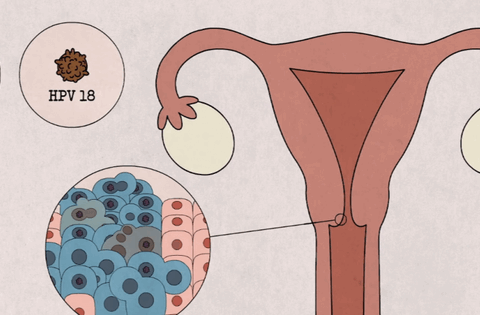 5 nhóm phụ nữ nên chú ý khám sàng lọc ung thư cổ tử cung