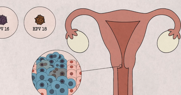 5 nhóm phụ nữ nên chú ý khám sàng lọc ung thư cổ tử cung