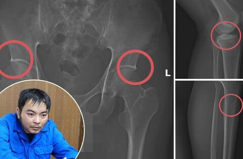 Cựu cán bộ y tế cầm đầu đường dây chuyên dùng búa đập vỡ xương, chiếm đoạt tiền bảo hiểm