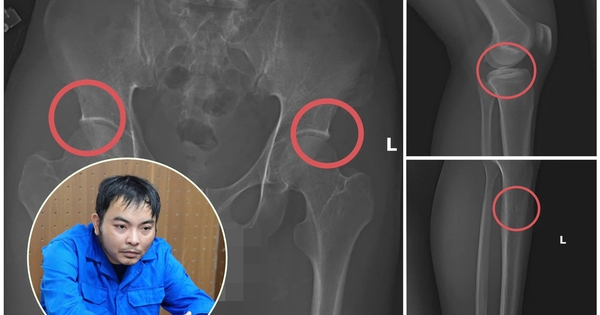 Cựu cán bộ y tế cầm đầu đường dây chuyên dùng búa đập vỡ xương, chiếm đoạt tiền bảo hiểm