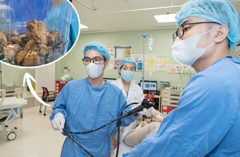 Nội soi lấy khối bã thức ăn “khổng lồ” 15cm trong dạ dày