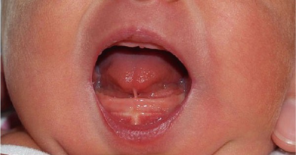 Trẻ bị ảnh hưởng như thế nào khi bị dính thắng lưỡi?