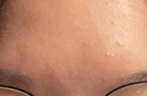 Con gái mọc mụn trứng cá, mẹ xin nghỉ phép đưa con đi cấp cứu