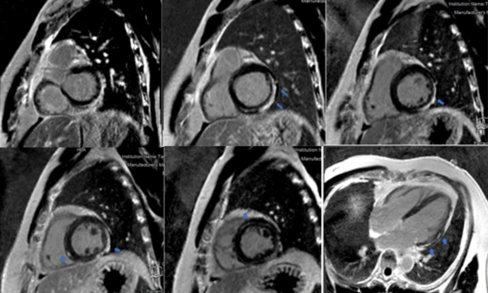 Viêm cơ tim tự miễn: kẻ thù thầm lặng ở trẻ nhỏ- Ảnh 2. Viêm cơ tim tự miễn: kẻ thù thầm lặng ở trẻ nhỏ- Ảnh 2.