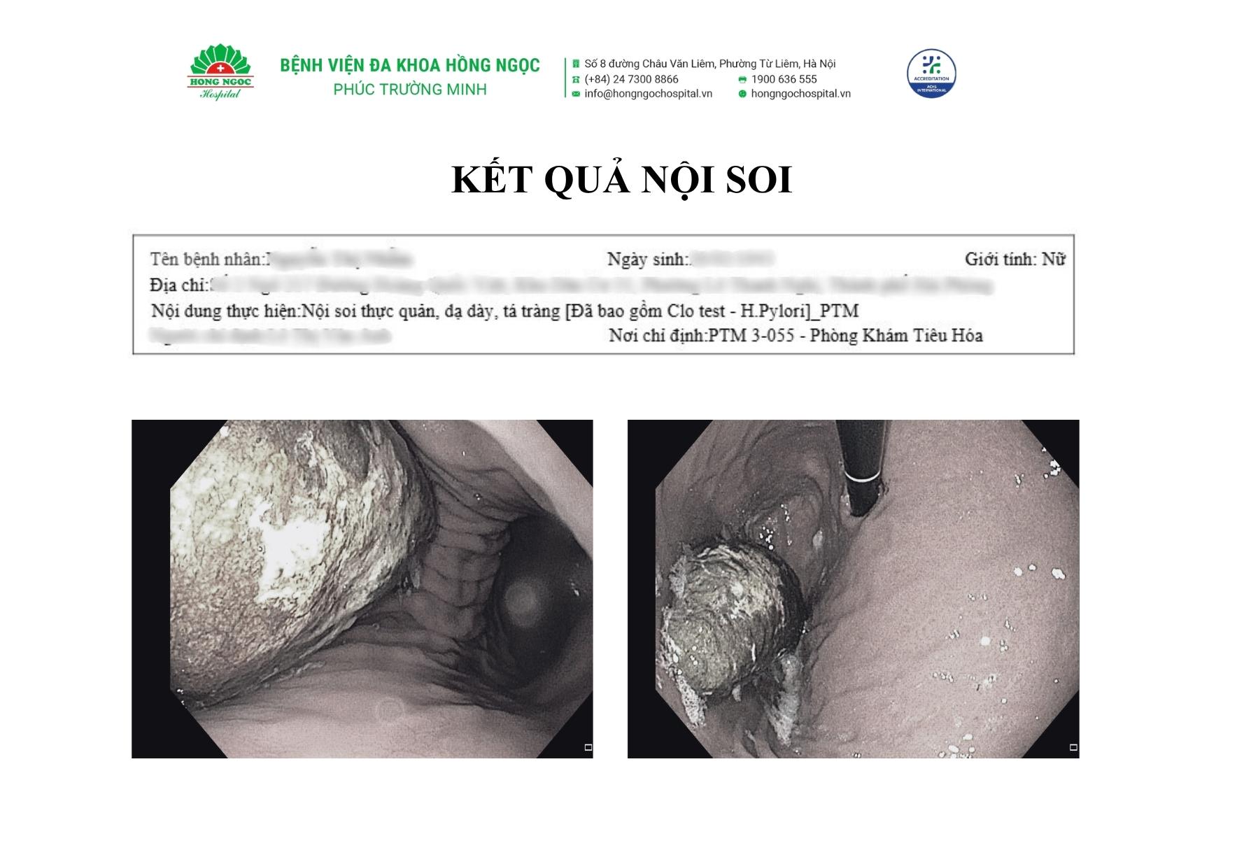 Nội soi lấy khối bã thức ăn 