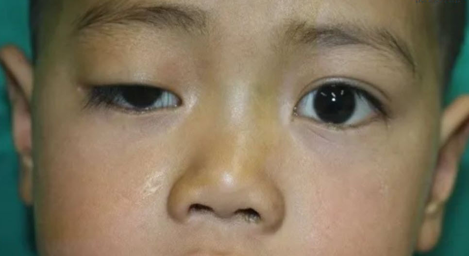 Trẻ mệt bất thường có thể mắc rối loạn nhược cơ bẩm sinh- Ảnh 1.