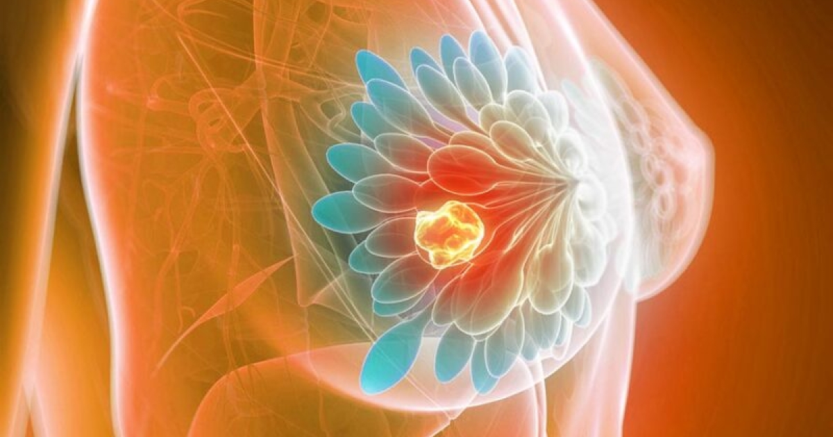 Phát hiện sớm ung thư vú nhờ ứng dụng AI trong chụp nhũ ảnh tầm soát- Ảnh 3.