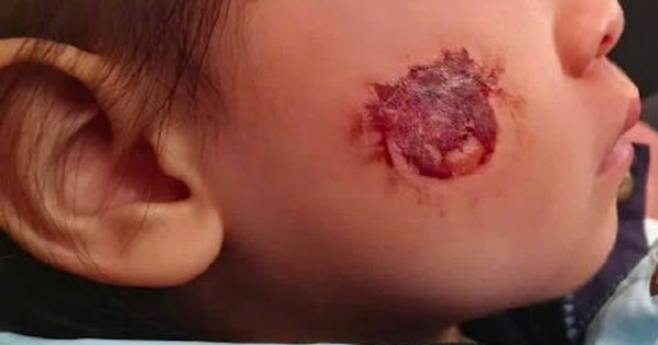 Bé gái 3 tuổi bị bỏng rộp cả mặt vì “miếng dán đồ chơi”: Nhiều đồ chơi hot trên mạng tuyệt đối không mua