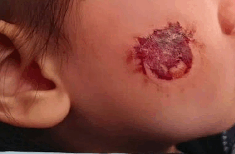 Bé gái 3 tuổi bị bỏng rộp cả mặt vì “miếng dán đồ chơi”: Nhiều đồ chơi hot trên mạng tuyệt đối không mua