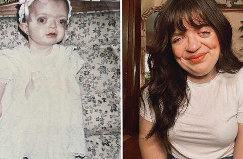 Tôi đã che giấu khuôn mặt suốt nhiều năm, nhưng giờ tôi tự hào chấp nhận vẻ khác biệt của chính mình