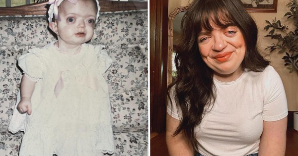 Tôi đã che giấu khuôn mặt suốt nhiều năm, nhưng giờ tôi tự hào chấp nhận vẻ khác biệt của chính mình