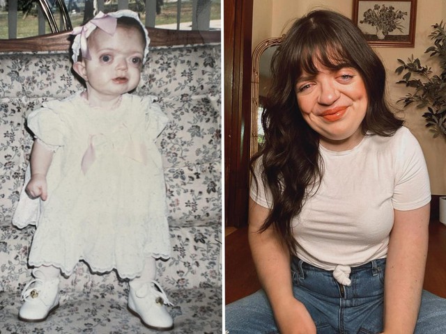 Tôi đã che giấu khuôn mặt suốt nhiều năm, nhưng giờ tôi tự hào chấp nhận vẻ khác biệt của chính mình- Ảnh 1.