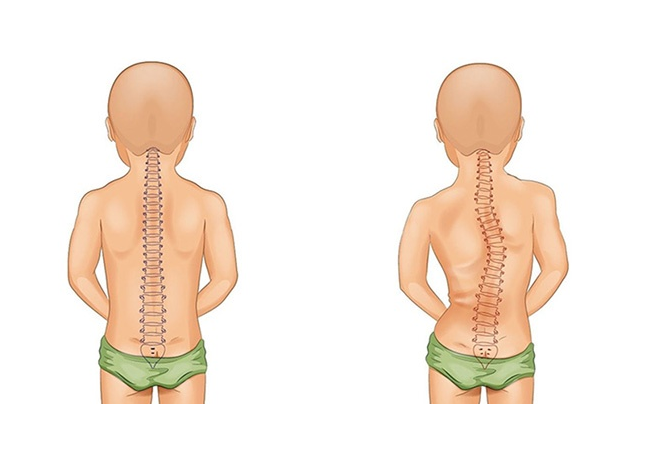 Làm gì khi trẻ gù lưng, cong vẹo cột sống do dùng điện thoại quá nhiều?- Ảnh 2. Làm gì khi trẻ gù lưng, cong vẹo cột sống do dùng điện thoại quá nhiều?- Ảnh 2.