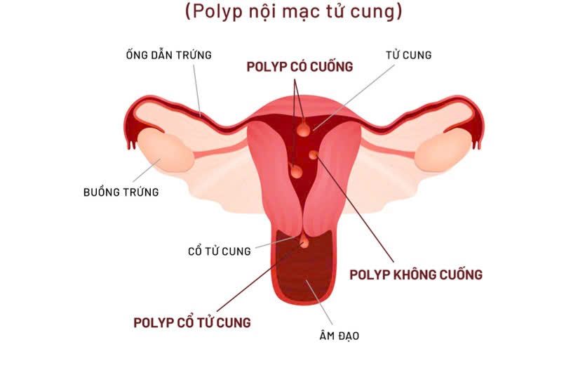 Phẫu thuật ca polyp buồng tử cung sa hẳn ra ngoài, mất máu nghiêm trọng: Bác sĩ cảnh báo không chủ quan với căn bệnh này!
- Ảnh 1. Phẫu thuật ca polyp buồng tử cung sa hẳn ra ngoài, mất máu nghiêm trọng: Bác sĩ cảnh báo không chủ quan với căn bệnh này!
- Ảnh 1.